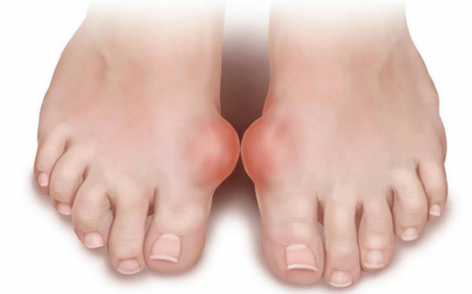 deformidade do pé como causa do aparecimento de fungos nas pernas