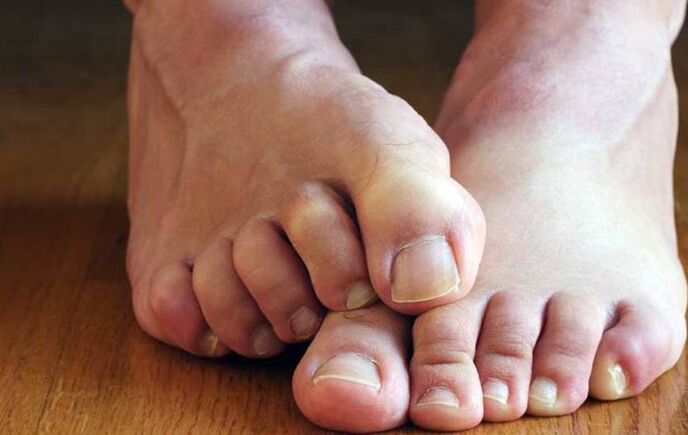 sintomas de fungo escamoso nos pés