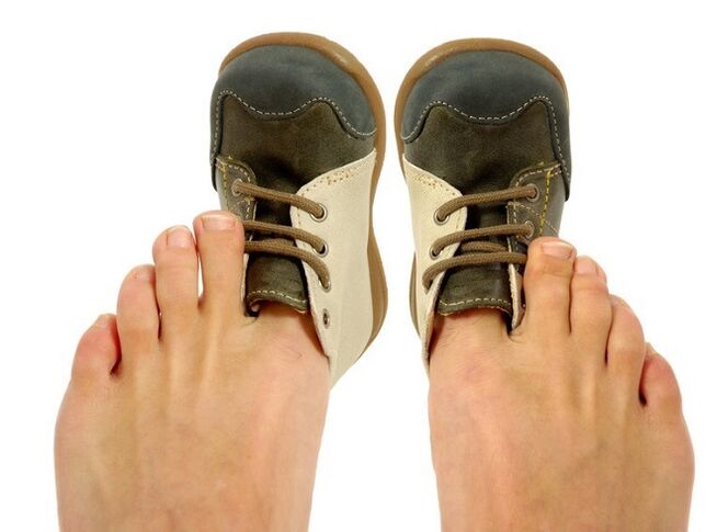 sapatos apertados como causa de fungos entre os dedos dos pés