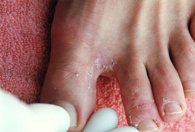 sintomas de fungos entre os dedos dos pés