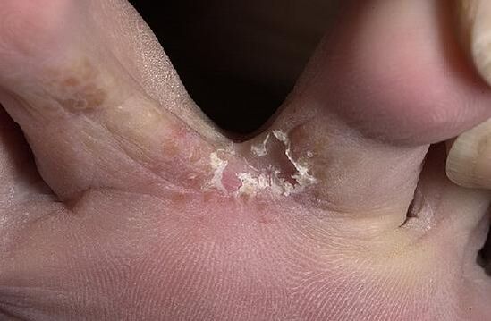 dedos dos pés afetados por fungos