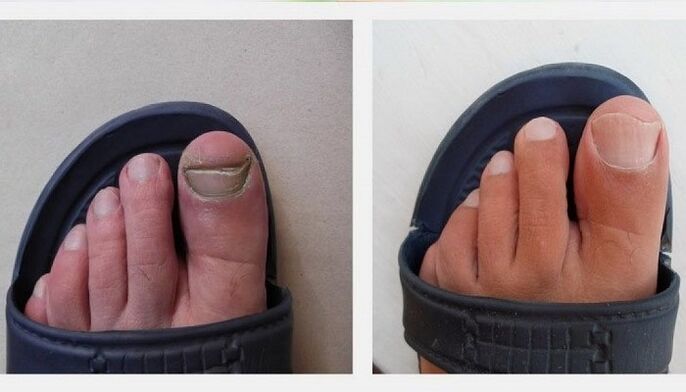 unhas dos pés antes e depois de tratar o fungo com vinagre de maçã
