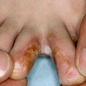 Sinais de fungo entre os dedos dos pés