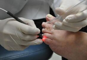 Tratamento a laser para fungos nas unhas