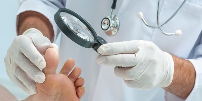 O médico examinou o pé infectado com um fungo