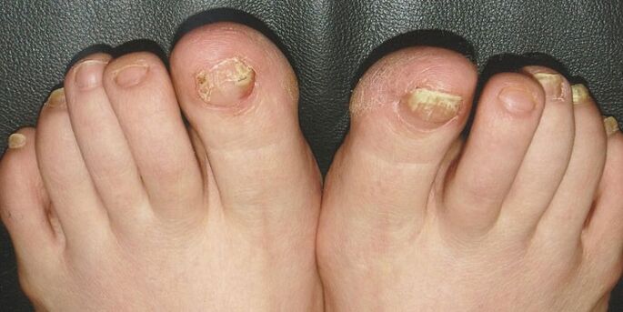 Onicomicose das unhas nas pernas