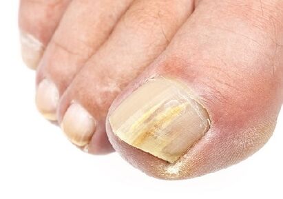 Como é o fungo das unhas