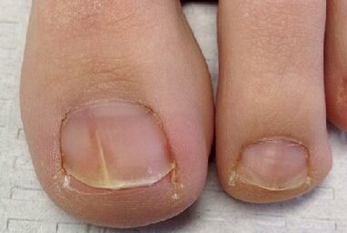Fungo das unhas dos dedos