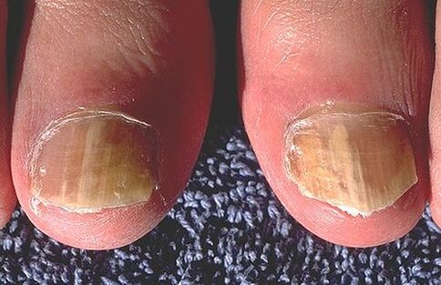 Unhas afetadas por dermatófitos