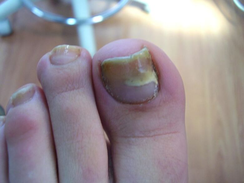 Como tratar unhas amareladas devido a fungos com gotas