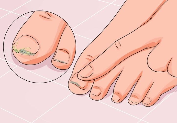 como tratar fungos nas unhas com gotas