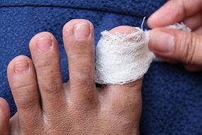 compressa para fungo nas unhas