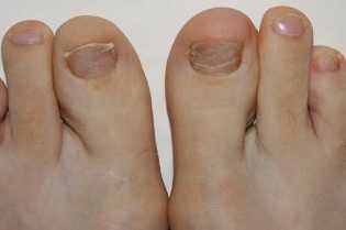 Os sintomas do aparecimento de bolor nos pés