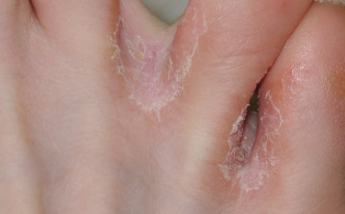 o fungo da pele nas pernas